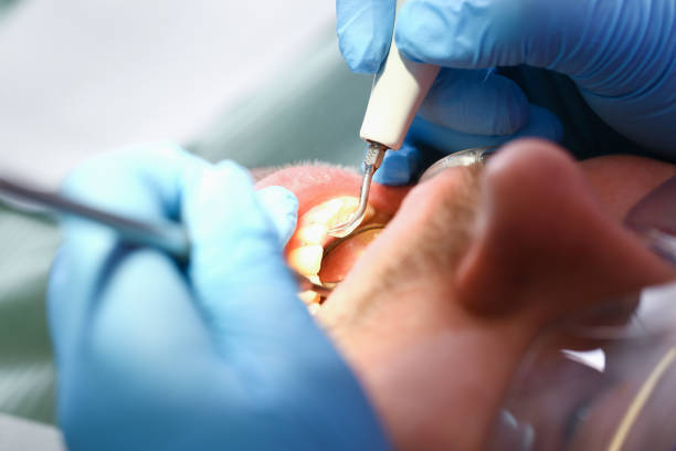 Best Emergency Dental Care for Broken or Chipped Teeth in Iowa, LA