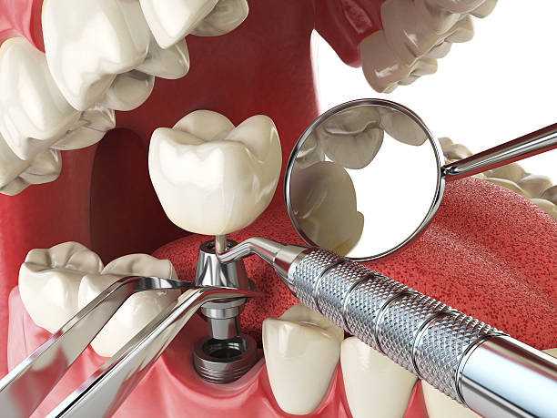 Best Emergency Wisdom Teeth Removal in Iowa, LA